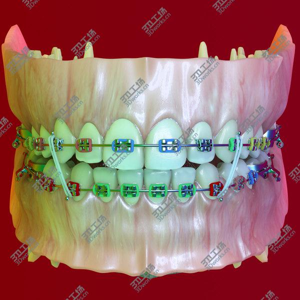 images/goods_img/20210312/Permanent Dentition with Braces/4.jpg